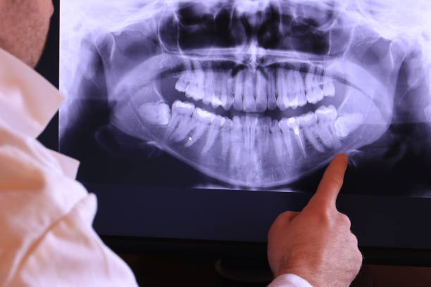 Best Emergency Tooth Extraction in Avimor, ID